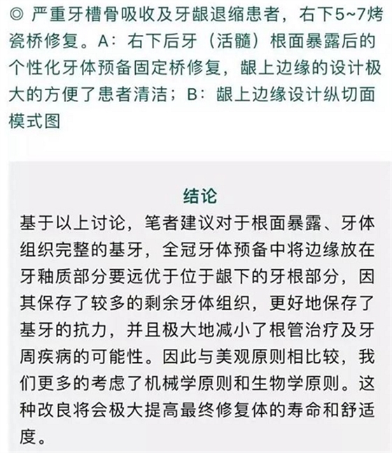 做全冠修復(fù)時基牙根面暴露，如何備牙？