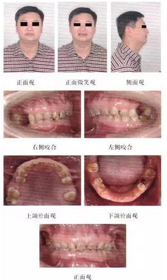 正畸修復(fù)聯(lián)合咬合重建1例 