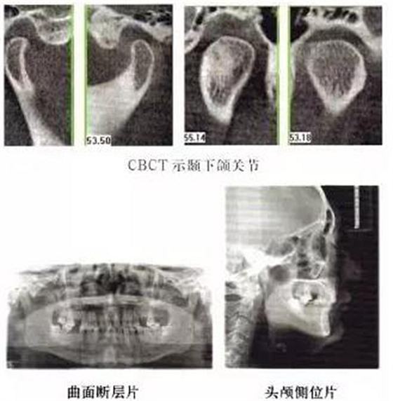 正畸修復(fù)聯(lián)合咬合重建1例 