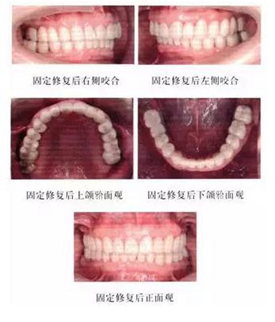 正畸修復(fù)聯(lián)合咬合重建1例 