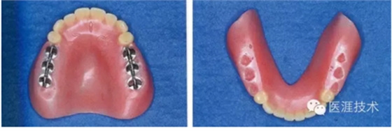 全口拔牙即戴全口活動(dòng)義齒修復(fù)病例 