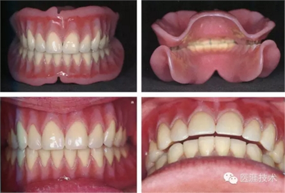 全口拔牙即戴全口活動(dòng)義齒修復(fù)病例 