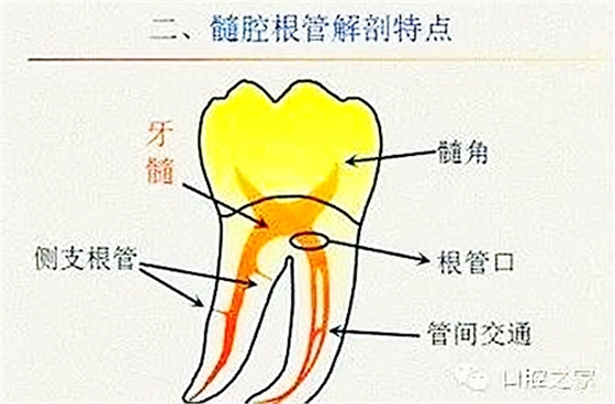 根管治療之根管口的探查要點  