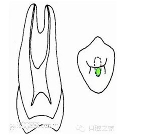 根管治療之根管口的探查要點  