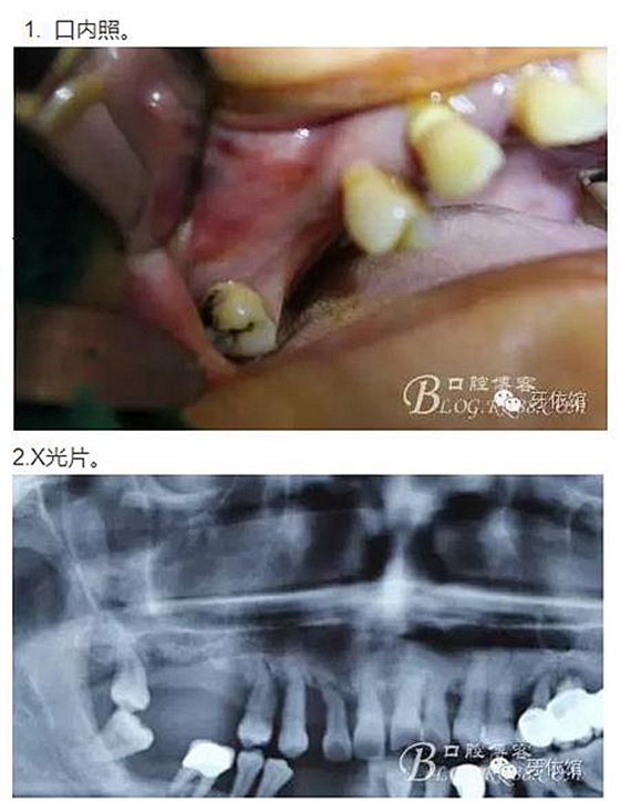 牙周病患者的外提升