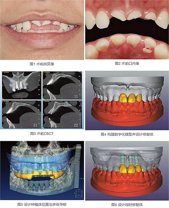 上頜多顆相鄰前牙的“精確化”即刻種植修復(fù)