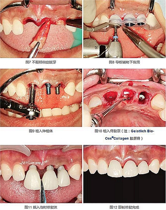 上頜多顆相鄰前牙的“精確化”即刻種植修復(fù)