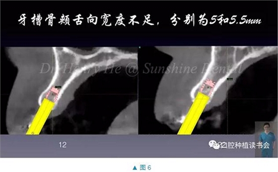 短種植體在前牙美學(xué)區(qū)應(yīng)用的臨床病例報道（上）