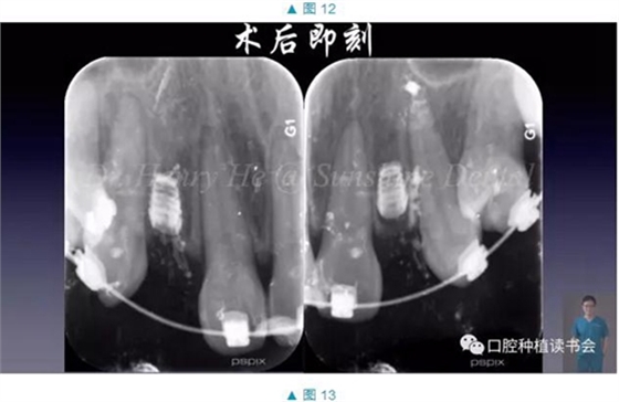 短種植體在前牙美學(xué)區(qū)應(yīng)用的臨床病例報道（上）