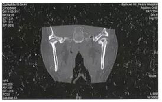 少見部位的下頜骨骨髓炎4例 