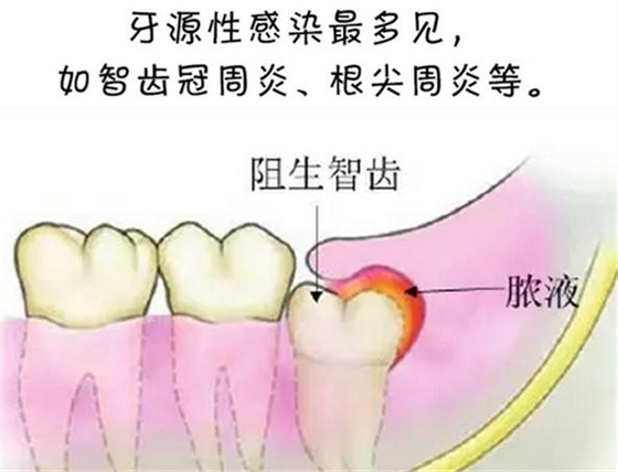 警惕！牙疼引發(fā)的間隙感染很危險(xiǎn)