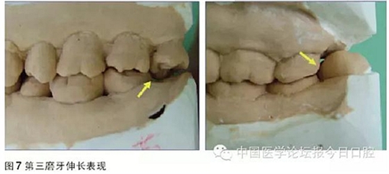 凸凹式后牙咬合接觸及其臨床意義——王美青教授