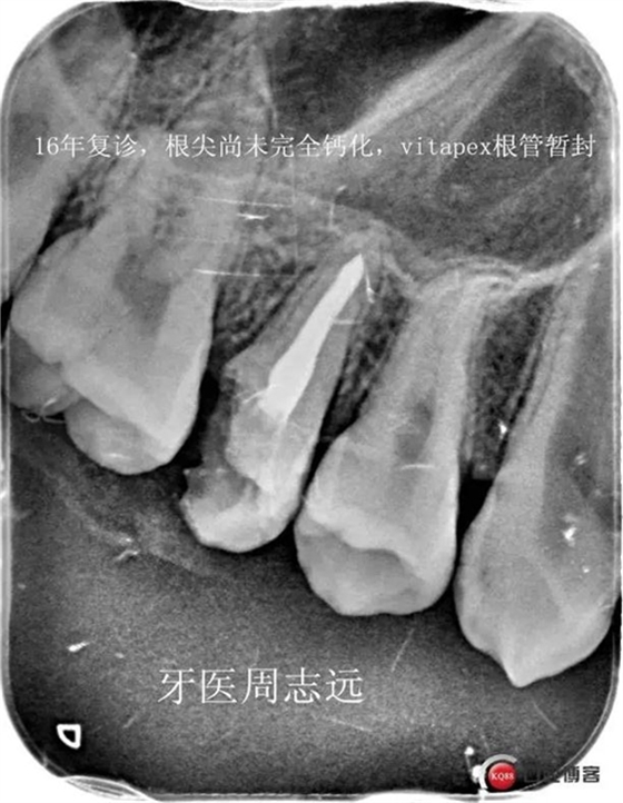 根尖誘導成型術(shù)   