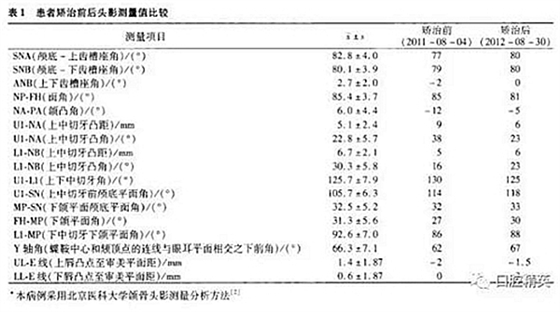 尖牙完全唇側(cè)錯位擁擠，矯正1例  