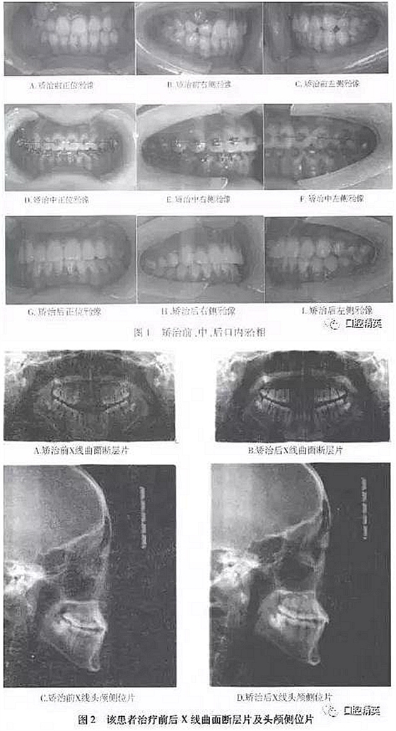 尖牙完全唇側(cè)錯位擁擠，矯正1例  