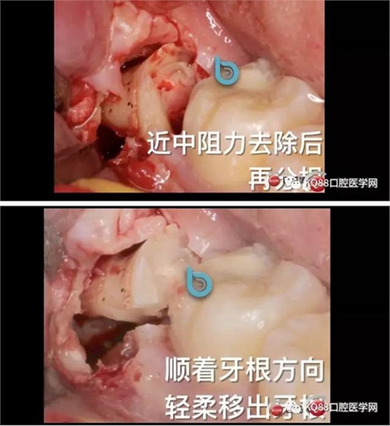 智齒拔除