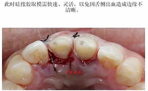 前牙外傷冠延長(zhǎng)+全瓷冠修復(fù)