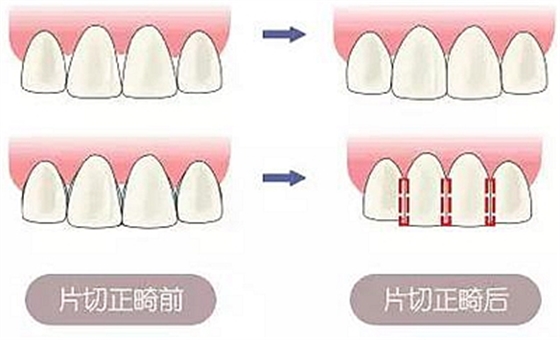 醫(yī)生方案里的鄰面去釉，究竟是什么？