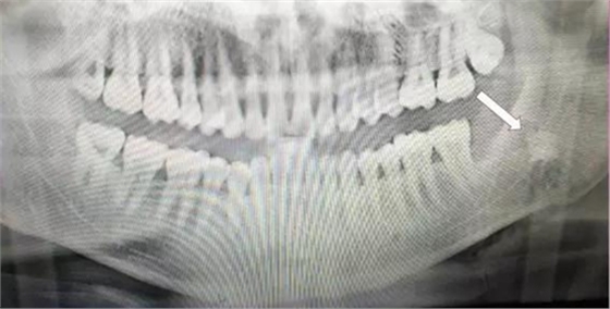 拔牙斷根的去與留？