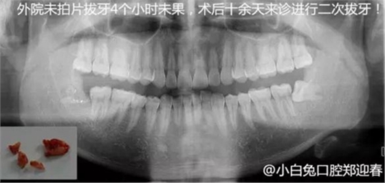 拔牙斷根的去與留？