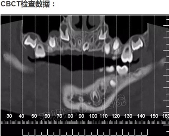 多生牙的拔除總原則：早發(fā)現(xiàn)，早處理！