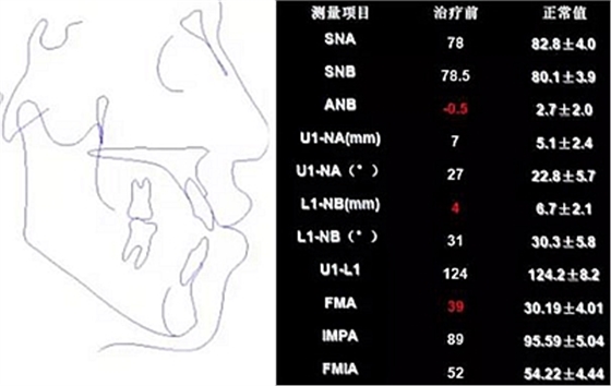 種植釘多維運用矯正高角反頜及開頜—對羅晨醫(yī)生專訪及病例展示（上）