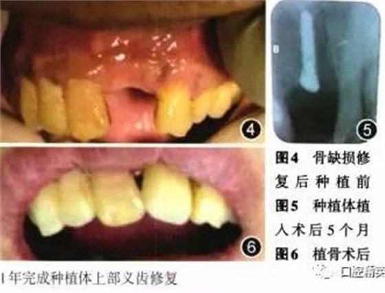 組織工程骨修復(fù)上頜骨缺損及牙種植一例 