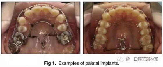 正畸文獻閱讀--上頜支抗初次植入失敗后二次植入穩(wěn)定性的研究