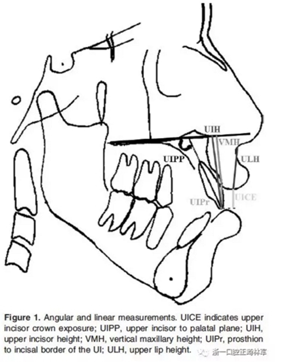 正畸文獻(xiàn)閱讀--在骨性II、III類開合中上中切牙牙冠暴露量的影響因素