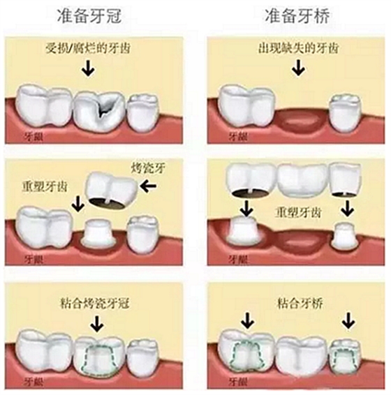 一位資深牙醫(yī)的總結(jié) | 如何減輕患者鑲牙后酸痛癥狀的措施！