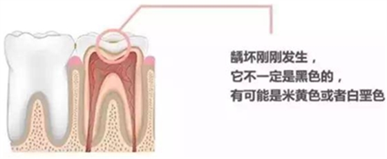 【收藏】關(guān)于補(bǔ)牙，知道這些就夠了！