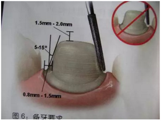 醫(yī)生，我的烤瓷牙上有個黑線怎么回事？