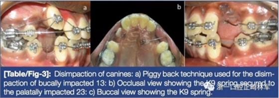 文獻(xiàn)優(yōu)秀正畸病例賞析--牙周加速成骨正畸（PAOO）輔助的腭側(cè)埋伏尖牙牽引矯治及5年跟蹤隨訪