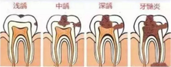 當(dāng)心“腹黑”齲齒，牙齒有個(gè)小洞也要補(bǔ)！