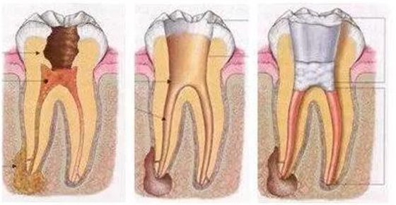 根管治療時(shí)4種殘髓處理方法1