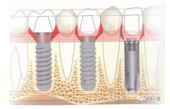 如何選擇種植牙，給《患者》推薦這篇文章就足矣