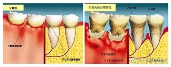 塞牙也是一種病