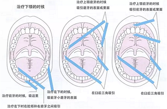 【齒科助手】診療時(shí)輔助基本