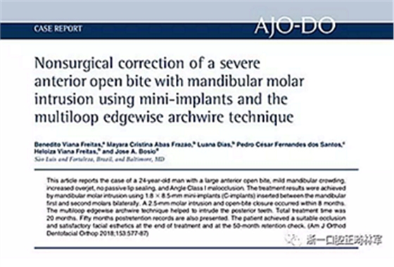 文獻優(yōu)秀正畸病例賞析-通過微種植釘及多曲方絲技術(shù)壓低下頜磨牙非手術(shù)矯治嚴(yán)重前牙開合患者1例
