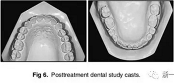 文獻優(yōu)秀正畸病例賞析-通過微種植釘及多曲方絲技術(shù)壓低下頜磨牙非手術(shù)矯治嚴(yán)重前牙開合患者1例