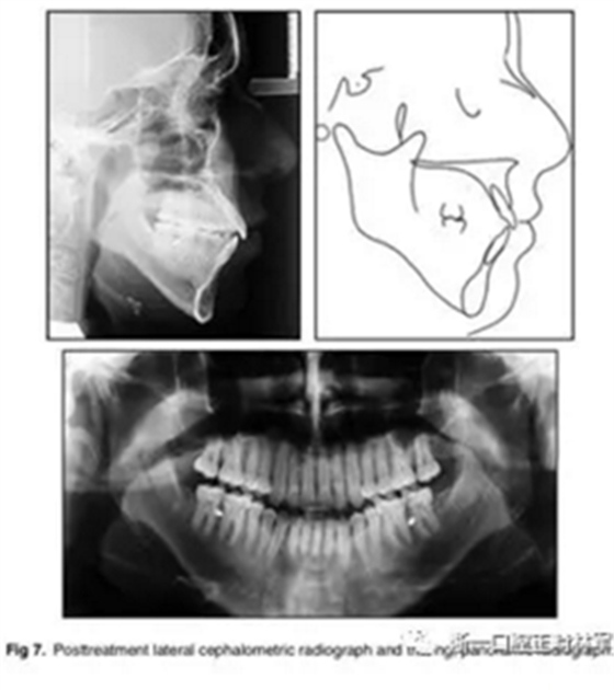 文獻優(yōu)秀正畸病例賞析-通過微種植釘及多曲方絲技術(shù)壓低下頜磨牙非手術(shù)矯治嚴(yán)重前牙開合患者1例