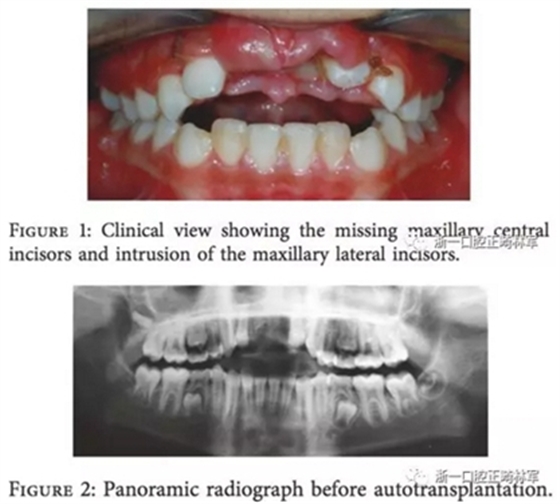 文獻優(yōu)秀正畸病例賞析--上頜中切牙區(qū)受傷后自體牙移植及正畸治療13年隨訪病例