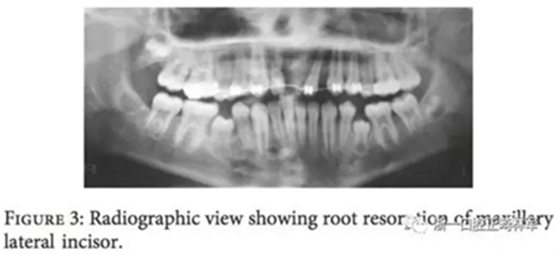 文獻優(yōu)秀正畸病例賞析--上頜中切牙區(qū)受傷后自體牙移植及正畸治療13年隨訪病例