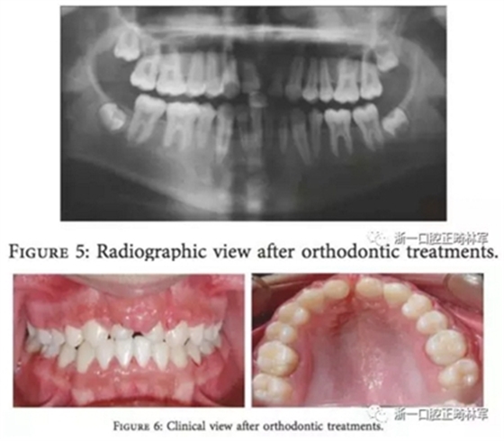 文獻優(yōu)秀正畸病例賞析--上頜中切牙區(qū)受傷后自體牙移植及正畸治療13年隨訪病例