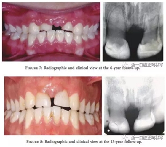 文獻優(yōu)秀正畸病例賞析--上頜中切牙區(qū)受傷后自體牙移植及正畸治療13年隨訪病例