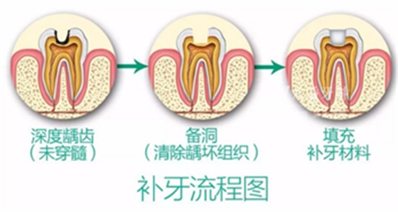 完全不懂，各種補(bǔ)牙材料，到底怎么選？