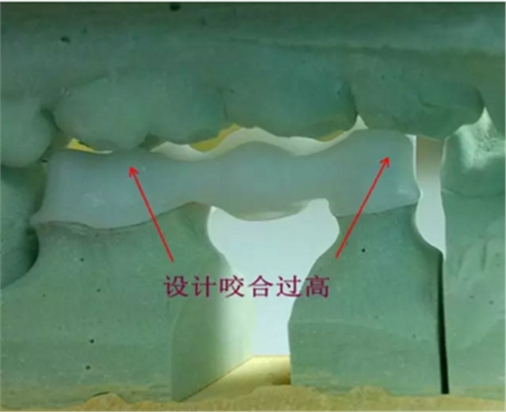 全鋯牙冠裂原因分析—操作流程工藝以及患者日常使用