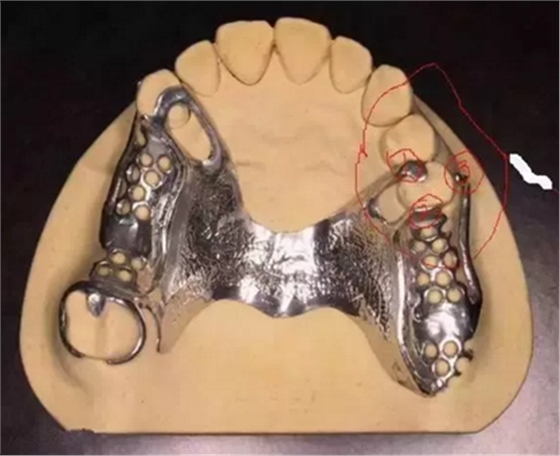 活動義齒修復，要懂的鋼托設計