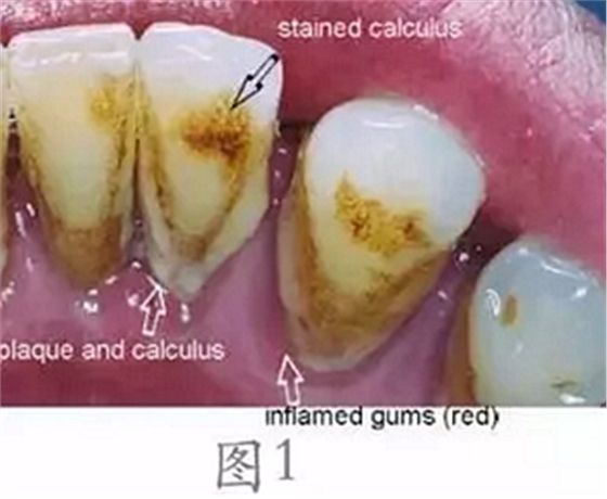 	 牙齦碰不得，一碰就出血。這是咋回事？