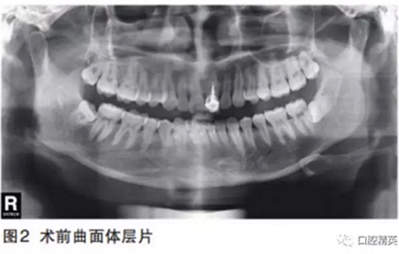 前牙即刻種植并個(gè)性化基臺(tái)美學(xué)修復(fù)